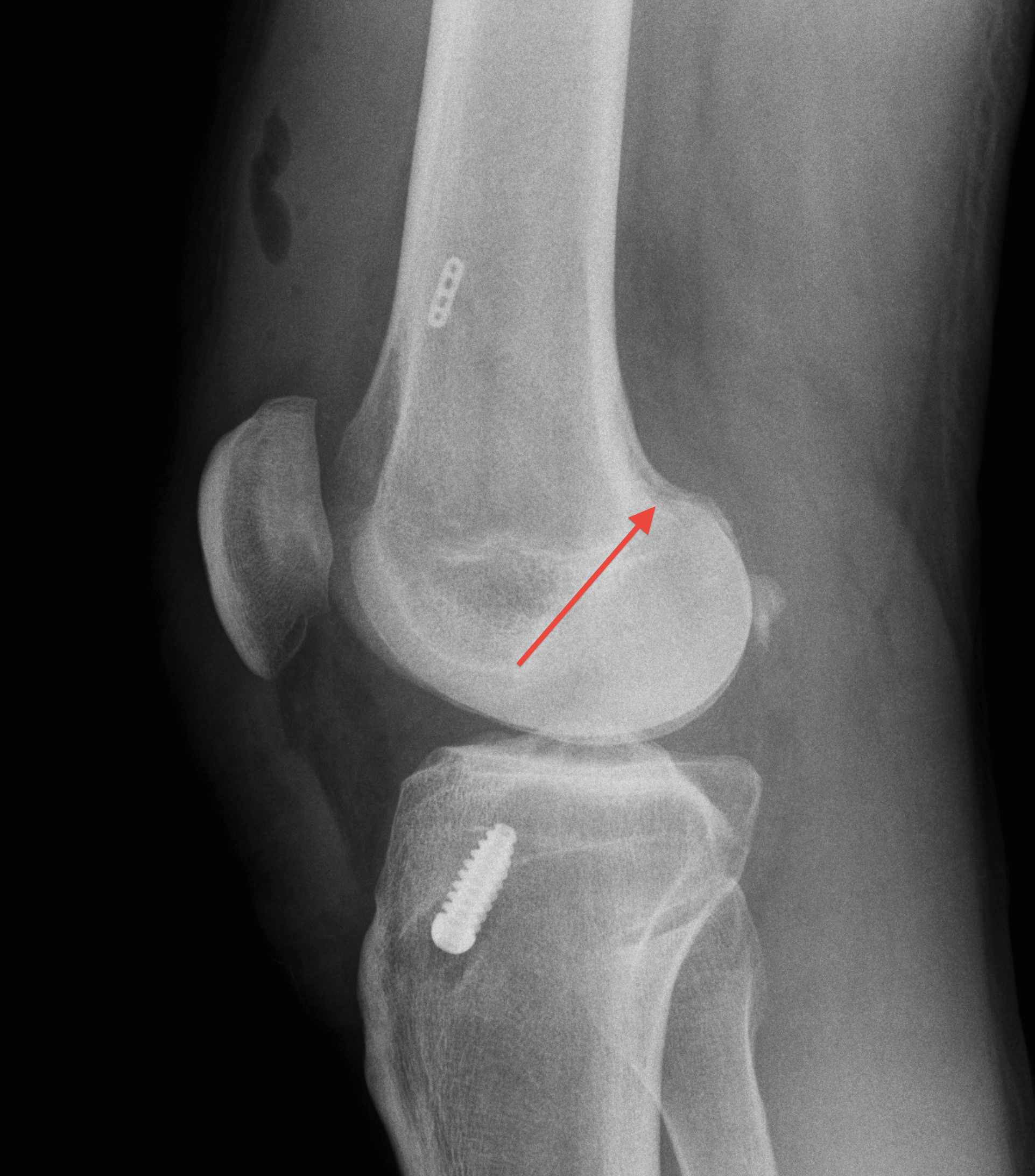 ACL Reconstruction Sagittal Tibial Tunnel